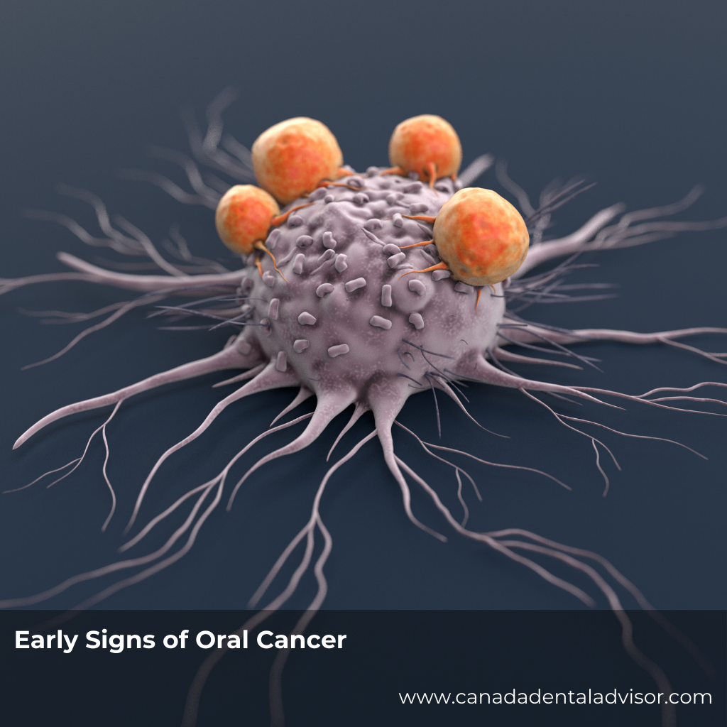 Early Signs of Oral Cancer