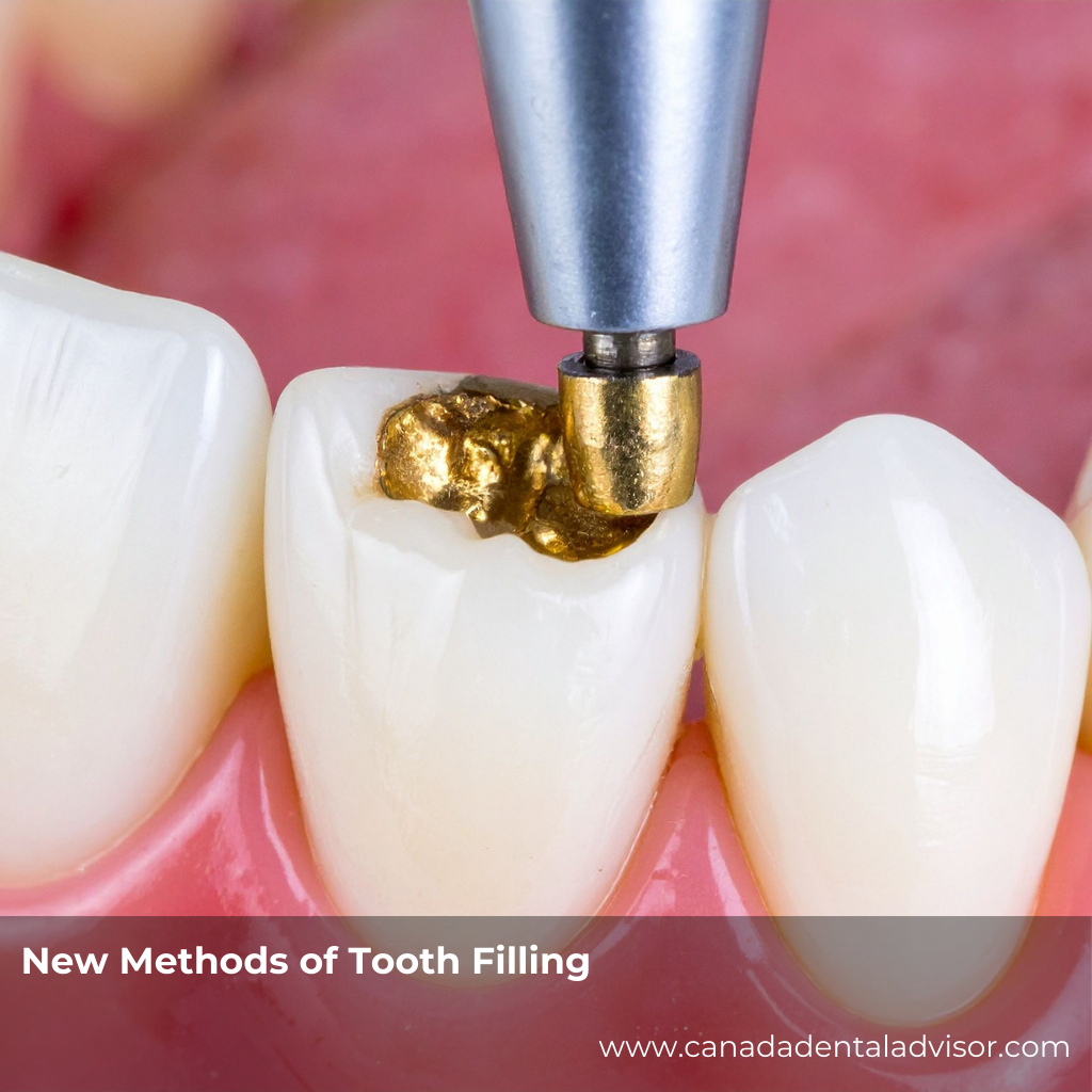 New Methods of Tooth Filling