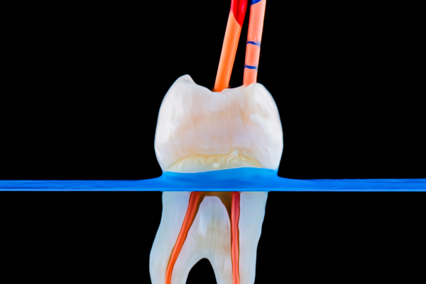 Root Canal Therapy with Microscope