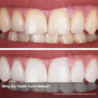 Why Do Teeth Turn Yellow?