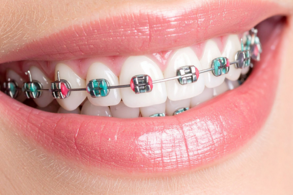 How Braces Improve Confidence