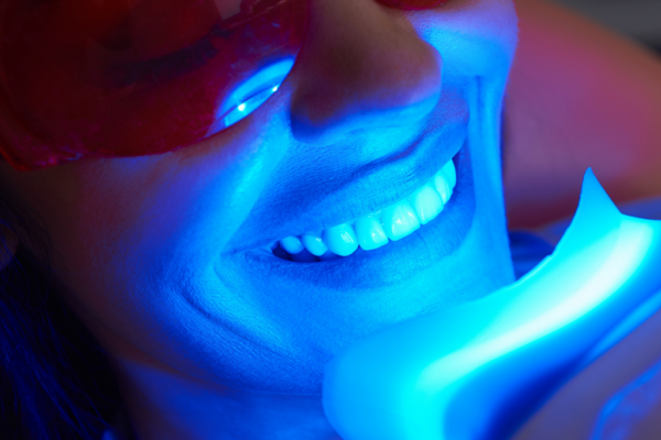 In-Office vs At-Home Teeth Whitening