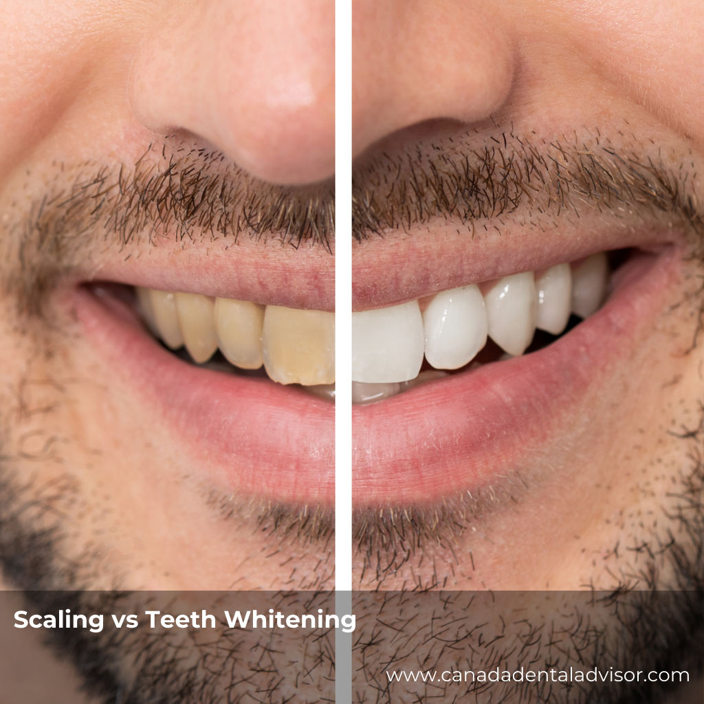 Scaling vs Teeth Whitening: What’s the Difference?